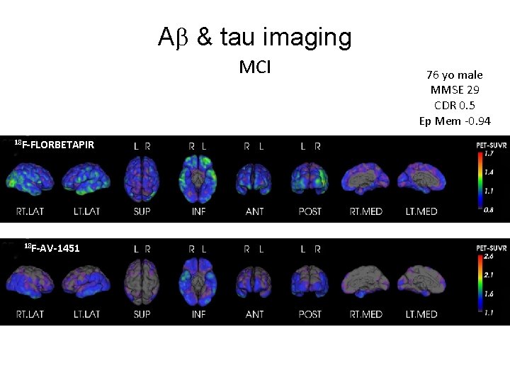 A & tau imaging MCI 18 F-FLORBETAPIR 18 F-AV-1451 76 yo male MMSE 29