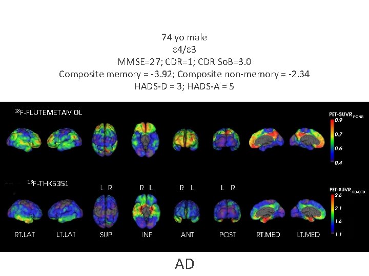 A and tau imaging in the diagnosis of dementia 74 yo male e 4/e