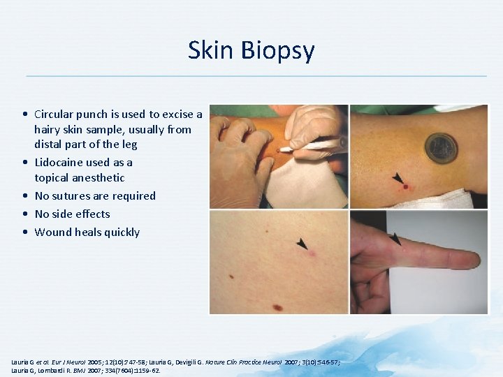 Skin Biopsy • Circular punch is used to excise a hairy skin sample, usually