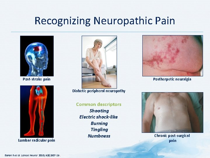 Recognizing Neuropathic Pain Post-stroke pain Postherpetic neuralgia Diabetic peripheral neuropathy Lumbar radicular pain 1.