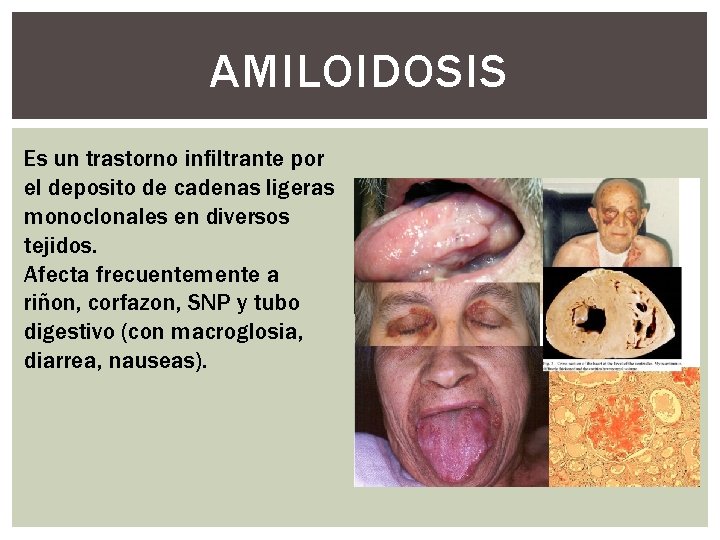 AMILOIDOSIS Es un trastorno infiltrante por el deposito de cadenas ligeras monoclonales en diversos AMILOIDOSIS Es un trastorno infiltrante por el deposito de cadenas ligeras monoclonales en diversos