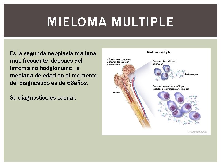 MIELOMA MULTIPLE Es la segunda neoplasia maligna mas frecuente despues del linfoma no hodgkiniano; MIELOMA MULTIPLE Es la segunda neoplasia maligna mas frecuente despues del linfoma no hodgkiniano;