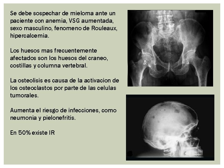 Se debe sospechar de mieloma ante un paciente con anemia, VSG aumentada, sexo masculino, Se debe sospechar de mieloma ante un paciente con anemia, VSG aumentada, sexo masculino,