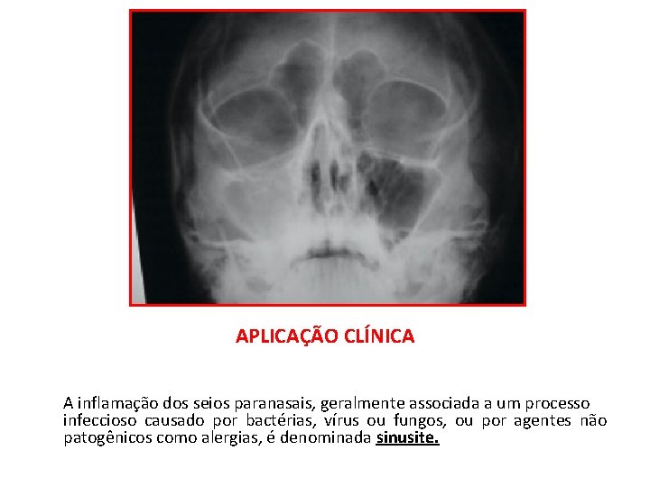 APLICAÇÃO CLÍNICA A inflamação dos seios paranasais, geralmente associada a um processo infeccioso causado