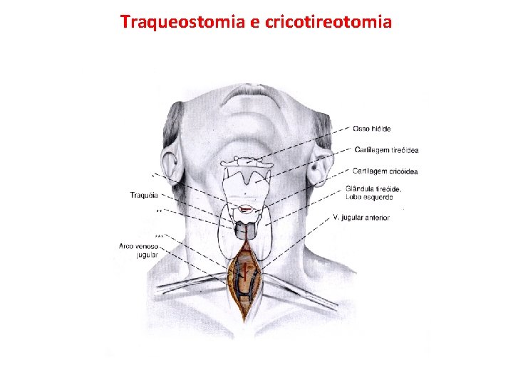 Traqueostomia e cricotireotomia 