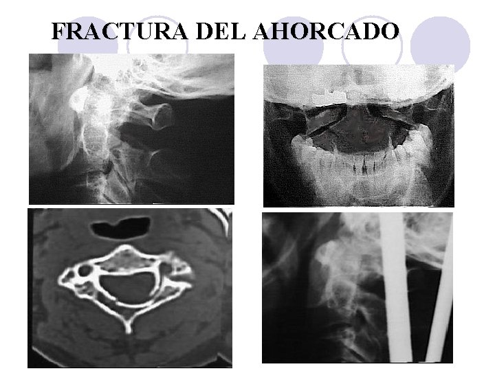 FRACTURA DEL AHORCADO 