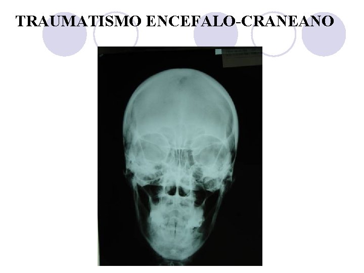 TRAUMATISMO ENCEFALO-CRANEANO 