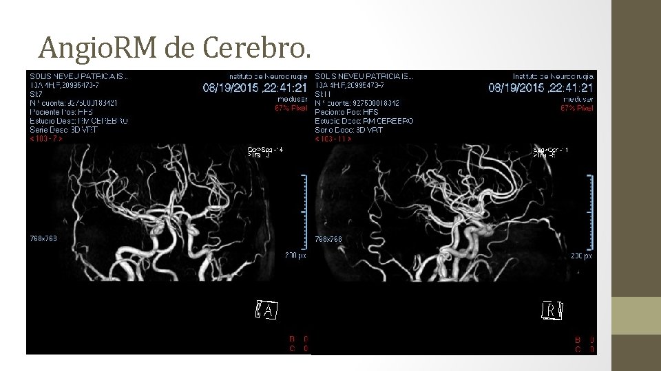 Angio. RM de Cerebro. 