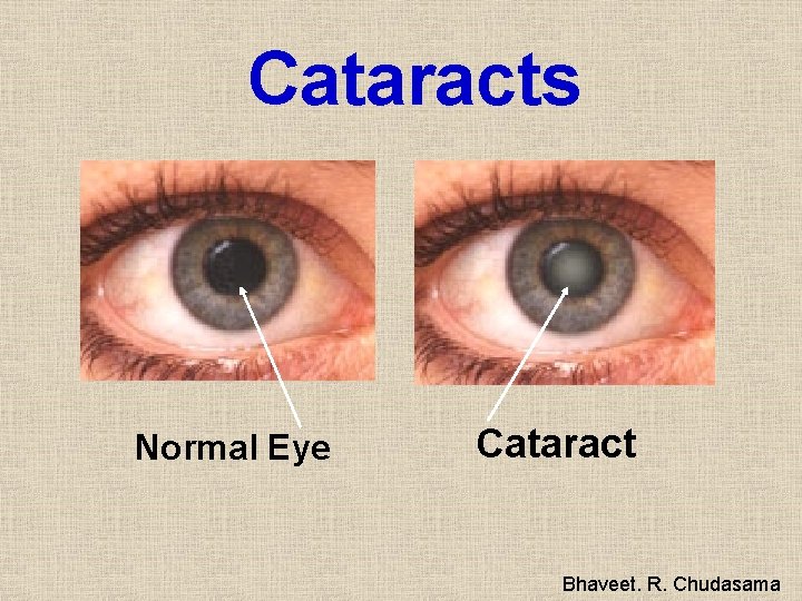 Cataracts Normal Eye Cataract Bhaveet. R. Chudasama 