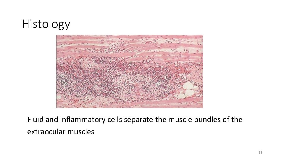 Histology Fluid and inflammatory cells separate the muscle bundles of the extraocular muscles 13