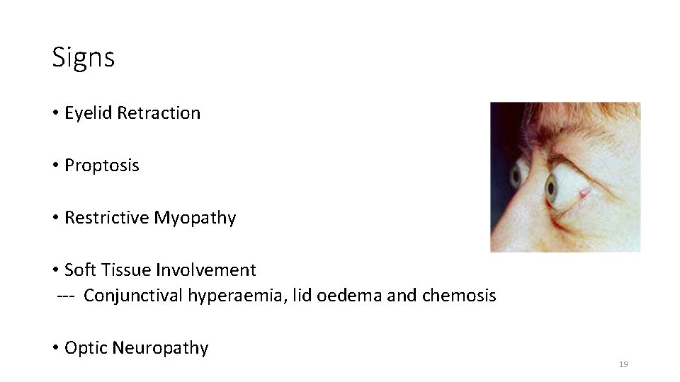 Signs • Eyelid Retraction • Proptosis • Restrictive Myopathy • Soft Tissue Involvement ---