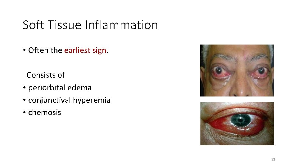 Soft Tissue Inflammation • Often the earliest sign. Consists of • periorbital edema •