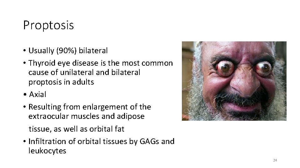 Proptosis • Usually (90%) bilateral • Thyroid eye disease is the most common cause