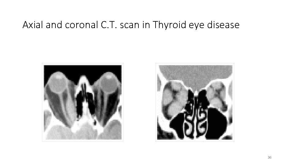 Axial and coronal C. T. scan in Thyroid eye disease 36 