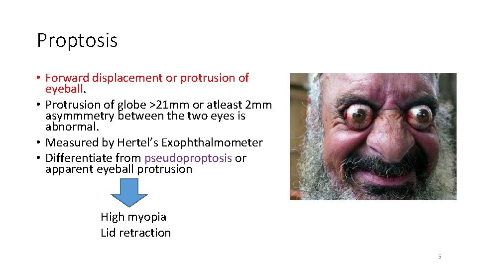 Proptosis • Forward displacement or protrusion of eyeball. • Protrusion of globe >21 mm