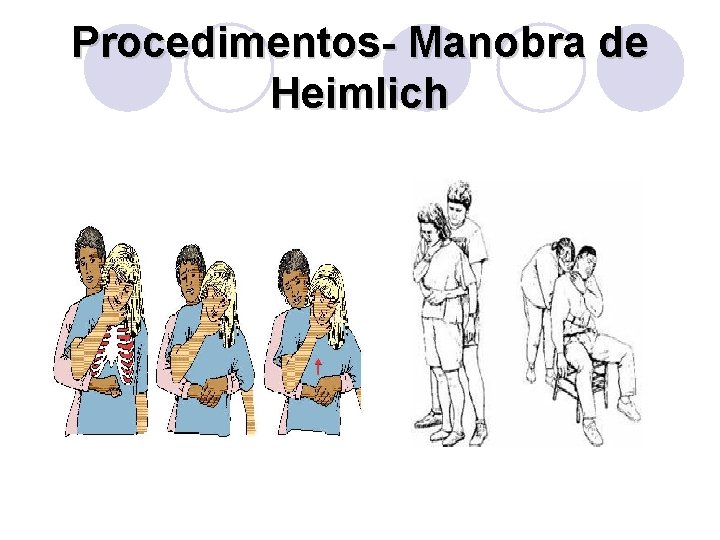 Procedimentos- Manobra de Heimlich 