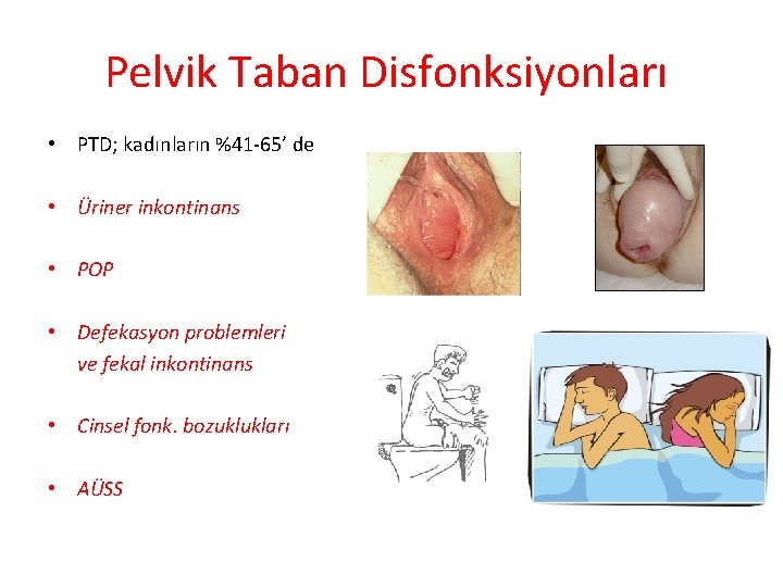 Pelvik Taban Disfonksiyonları • PTD; kadınların %41 -65’ de • Üriner inkontinans • POP