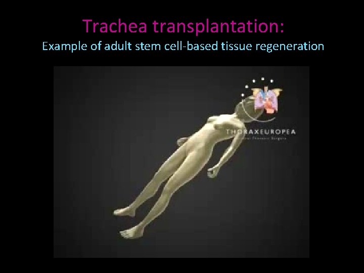 Trachea transplantation: Example of adult stem cell-based tissue regeneration 