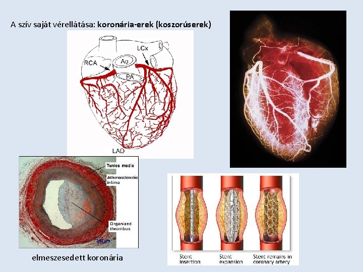 A szív saját vérellátása: koronária-erek (koszorúserek) elmeszesedett koronária 