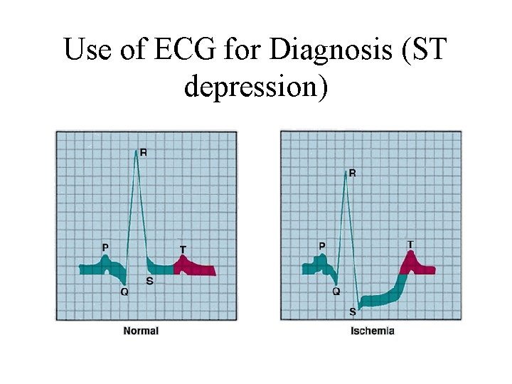 Use of ECG for Diagnosis (ST depression) 