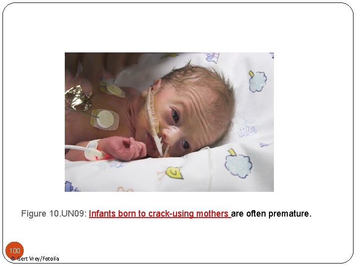 Figure 10. UN 09: Infants born to crack-using mothers are often premature. 100 ©