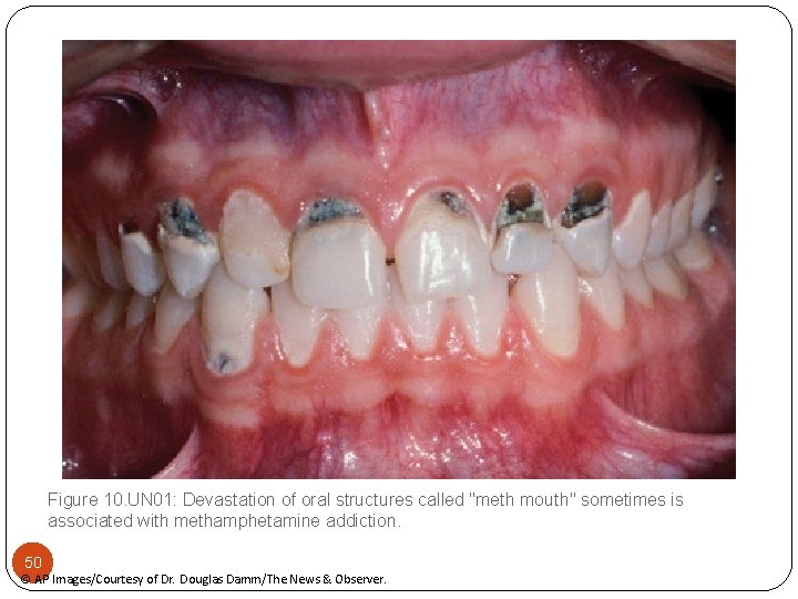 Figure 10. UN 01: Devastation of oral structures called "meth mouth" sometimes is associated