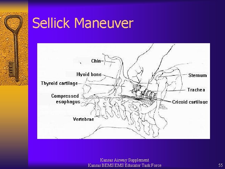 Sellick Maneuver Kansas Airway Supplement Kansas BEMS Educator Task Force 55 