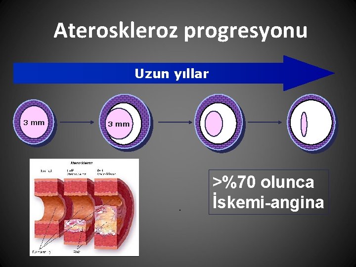 Ateroskleroz progresyonu Uzun yıllar 3 mm >%70 olunca İskemi-angina 