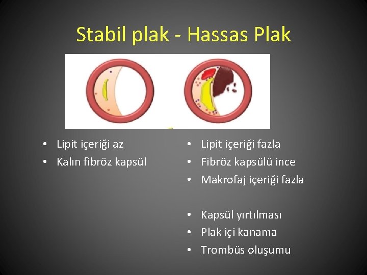 Stabil plak - Hassas Plak • Lipit içeriği az • Kalın fibröz kapsül •