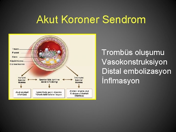 Akut Koroner Sendrom Trombüs oluşumu Vasokonstruksiyon Distal embolizasyon İnflmasyon 