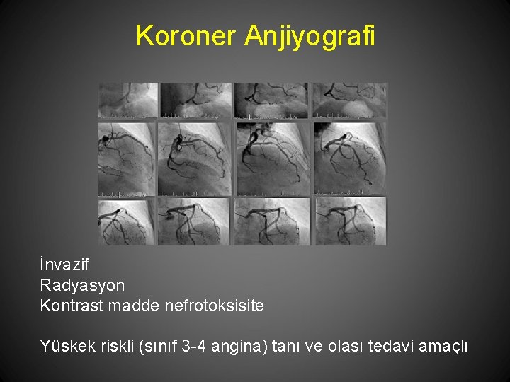 Koroner Anjiyografi İnvazif Radyasyon Kontrast madde nefrotoksisite Yüskek riskli (sınıf 3 -4 angina) tanı