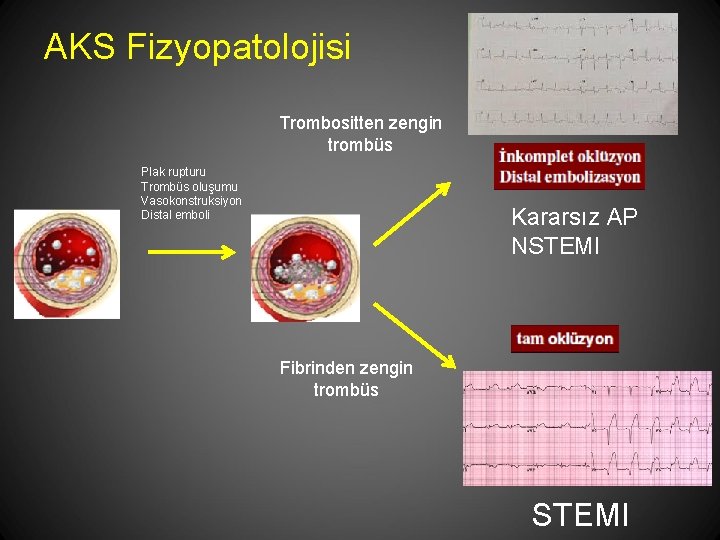 AKS Fizyopatolojisi Trombositten zengin trombüs Plak rupturu Trombüs oluşumu Vasokonstruksiyon Distal emboli Kararsız AP