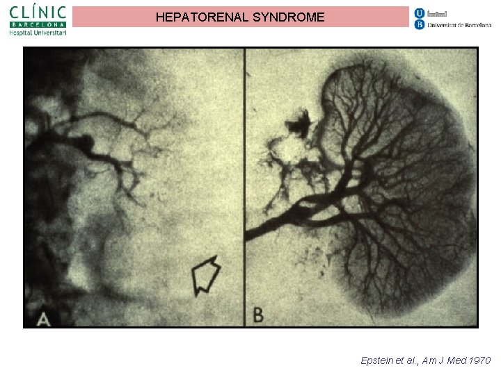 HEPATORENAL SYNDROME Epstein et al. , Am J Med 1970 HEPATORENAL SYNDROME Epstein et al. , Am J Med 1970