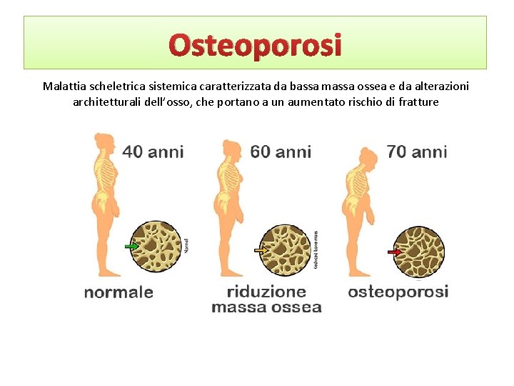 Osteoporosi Malattia scheletrica sistemica caratterizzata da bassa massa ossea e da alterazioni architetturali dell’osso,