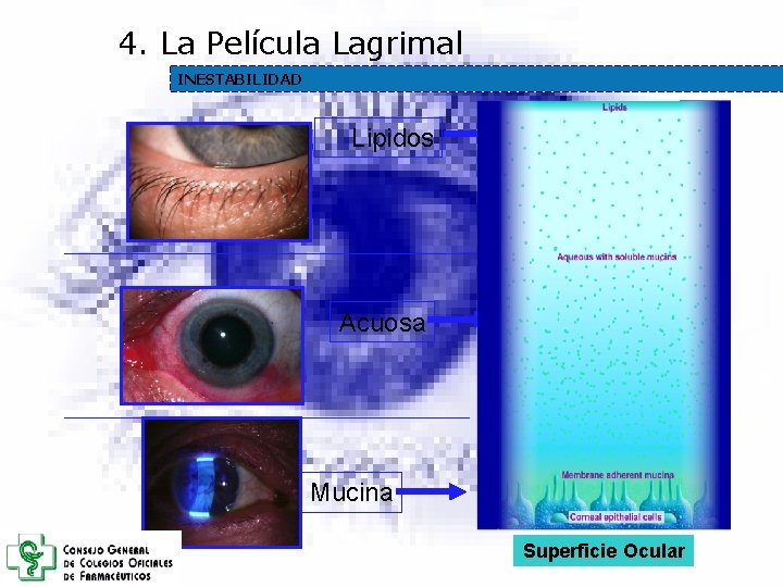 4. La Película Lagrimal INESTABILIDAD Lipidos Acuosa Mucina Superficie Ocular 4. La Película Lagrimal INESTABILIDAD Lipidos Acuosa Mucina Superficie Ocular