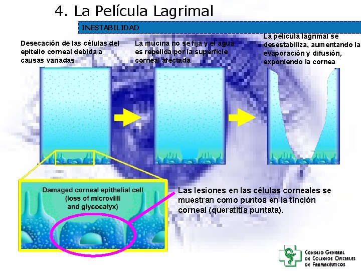4. La Película Lagrimal INESTABILIDAD Desecación de las células del epitelio corneal debida a 4. La Película Lagrimal INESTABILIDAD Desecación de las células del epitelio corneal debida a
