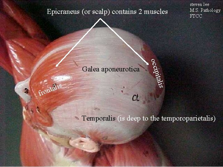 Epicraneus (or scalp) contains 2 muscles italis is l a t ron occip Galea