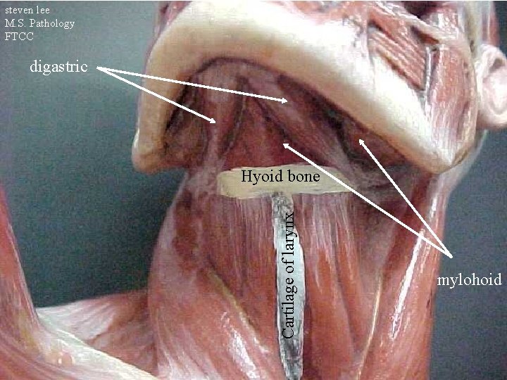 steven lee M. S. Pathology FTCC digastric Cartilage of larynx Hyoid bone mylohoid 