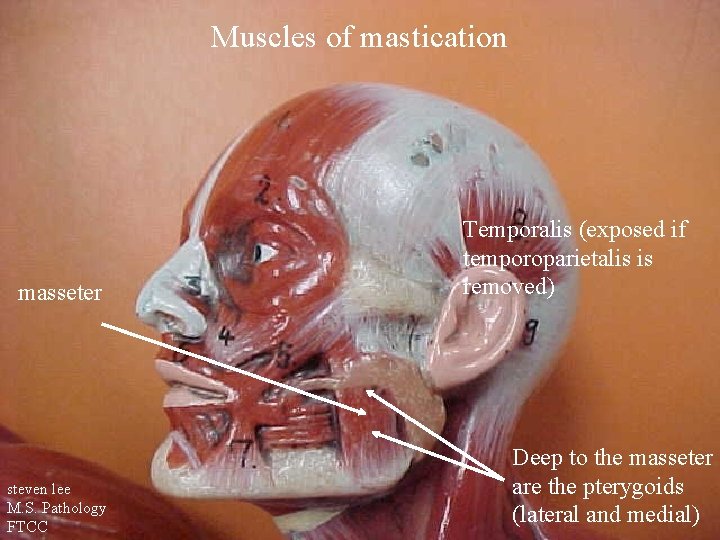 Muscles of mastication masseter steven lee M. S. Pathology FTCC Temporalis (exposed if temporoparietalis