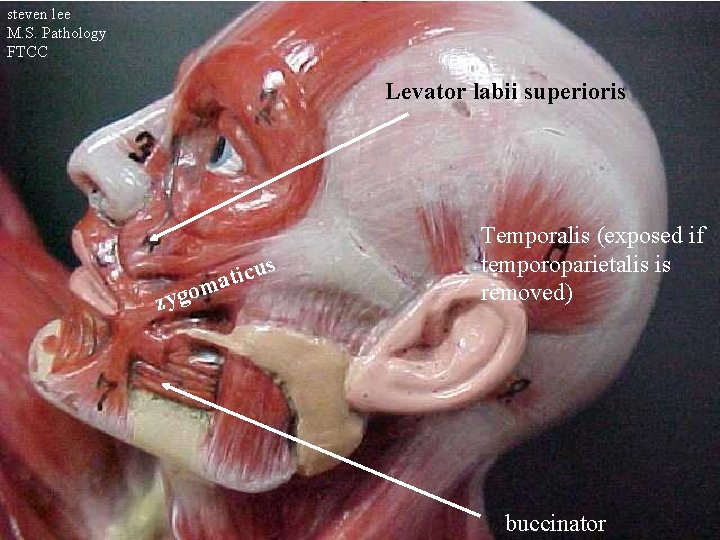 steven lee M. S. Pathology FTCC Levator labii superioris zyg us c i t