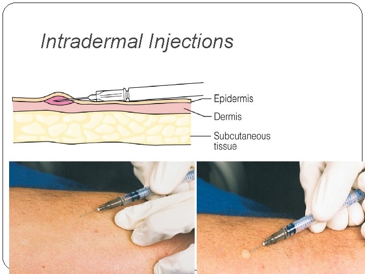 Intradermal Injections 