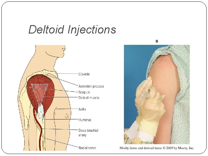 Deltoid Injections 