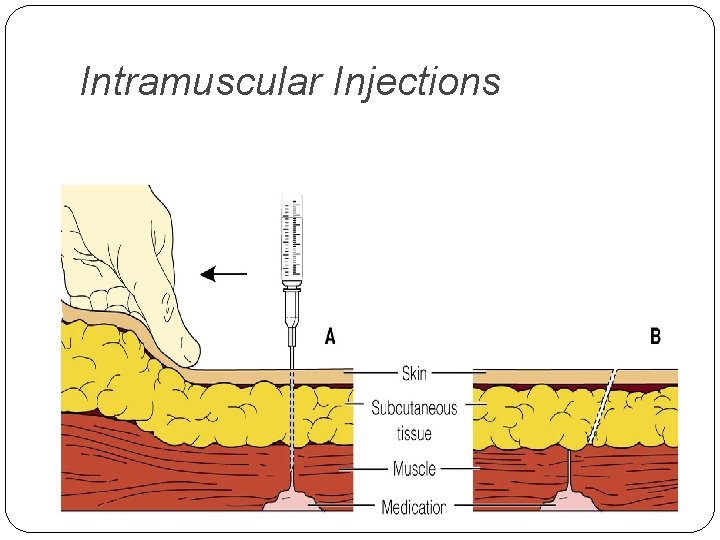 Intramuscular Injections 