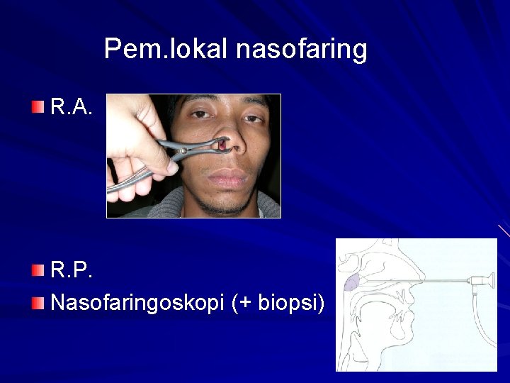 Pem. lokal nasofaring R. A. R. P. Nasofaringoskopi (+ biopsi) Pem. lokal nasofaring R. A. R. P. Nasofaringoskopi (+ biopsi)