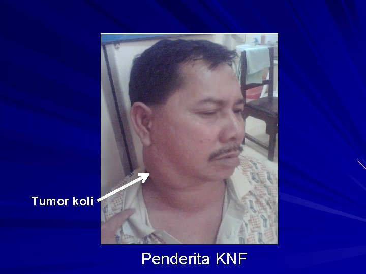 Tumor koli Penderita KNF Tumor koli Penderita KNF