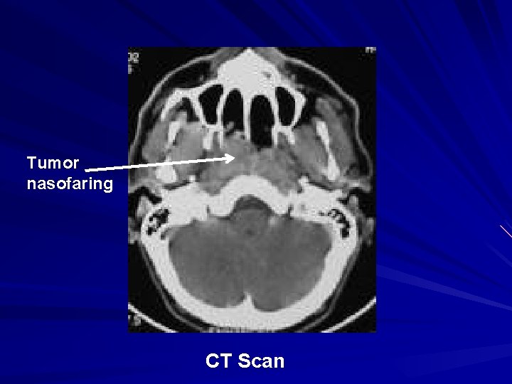 Tumor nasofaring CT Scan Tumor nasofaring CT Scan