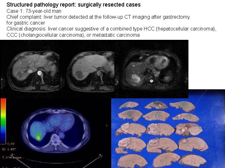Structured pathology report: surgically resected cases Case 1: 73 -year-old man Chief complaint: liver Structured pathology report: surgically resected cases Case 1: 73 -year-old man Chief complaint: liver