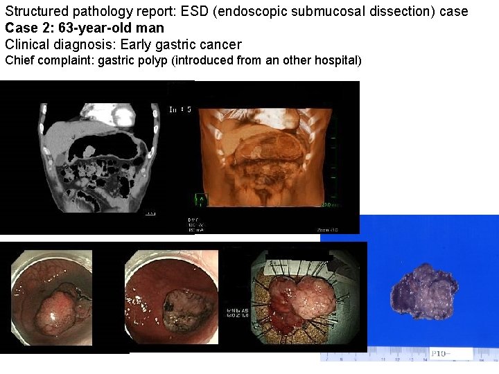 Structured pathology report: ESD (endoscopic submucosal dissection) case Case 2: 63 -year-old man Clinical Structured pathology report: ESD (endoscopic submucosal dissection) case Case 2: 63 -year-old man Clinical