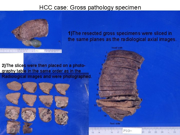 HCC case: Gross pathology specimen 1 1)The resected gross specimens were sliced in the HCC case: Gross pathology specimen 1 1)The resected gross specimens were sliced in the