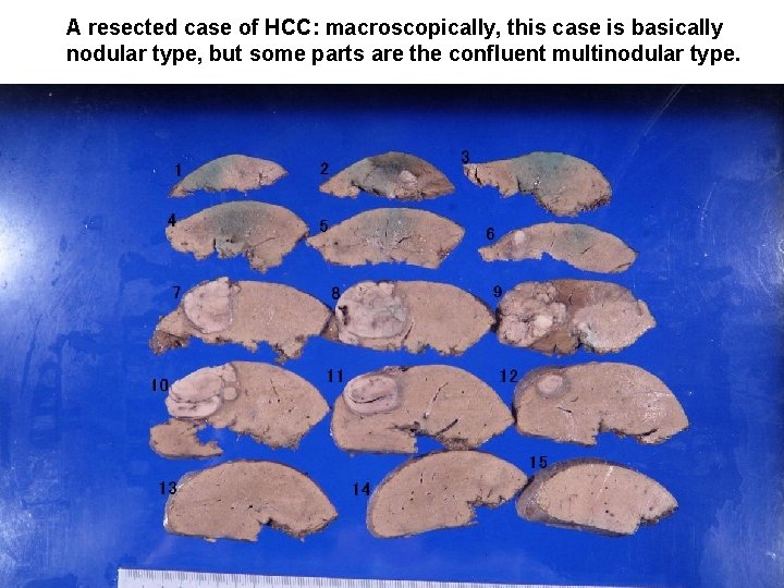 A resected case of HCC: macroscopically, this case is basically nodular type, but some A resected case of HCC: macroscopically, this case is basically nodular type, but some